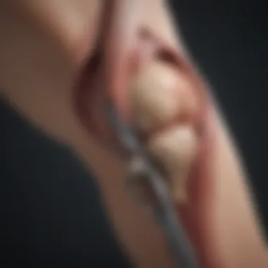 Surgical Techniques in Popliteal Femoral Bypass Illustration of the surgical techniques used in popliteal femoral bypass.