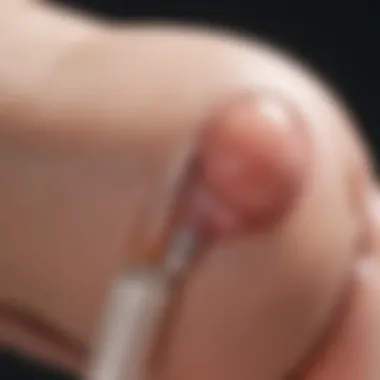 Placement of the Contraceptive Implant Illustration of the contraceptive arm implant placement