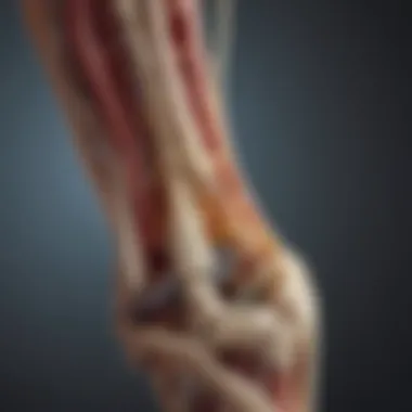Diagram of Stress Fractures Diagram depicting stress fractures in the shin